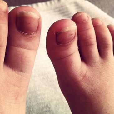 long toe nails